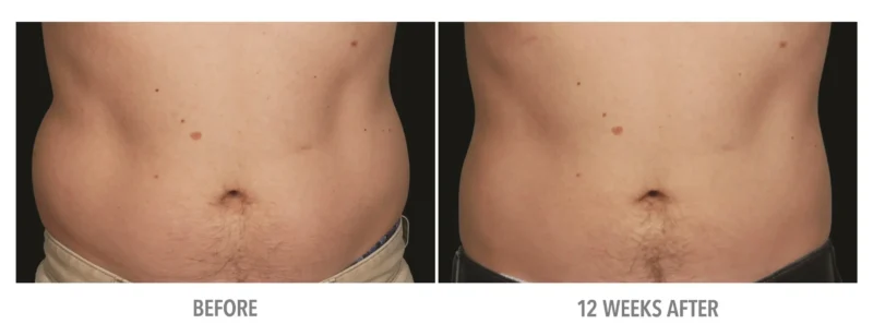 Abdomen