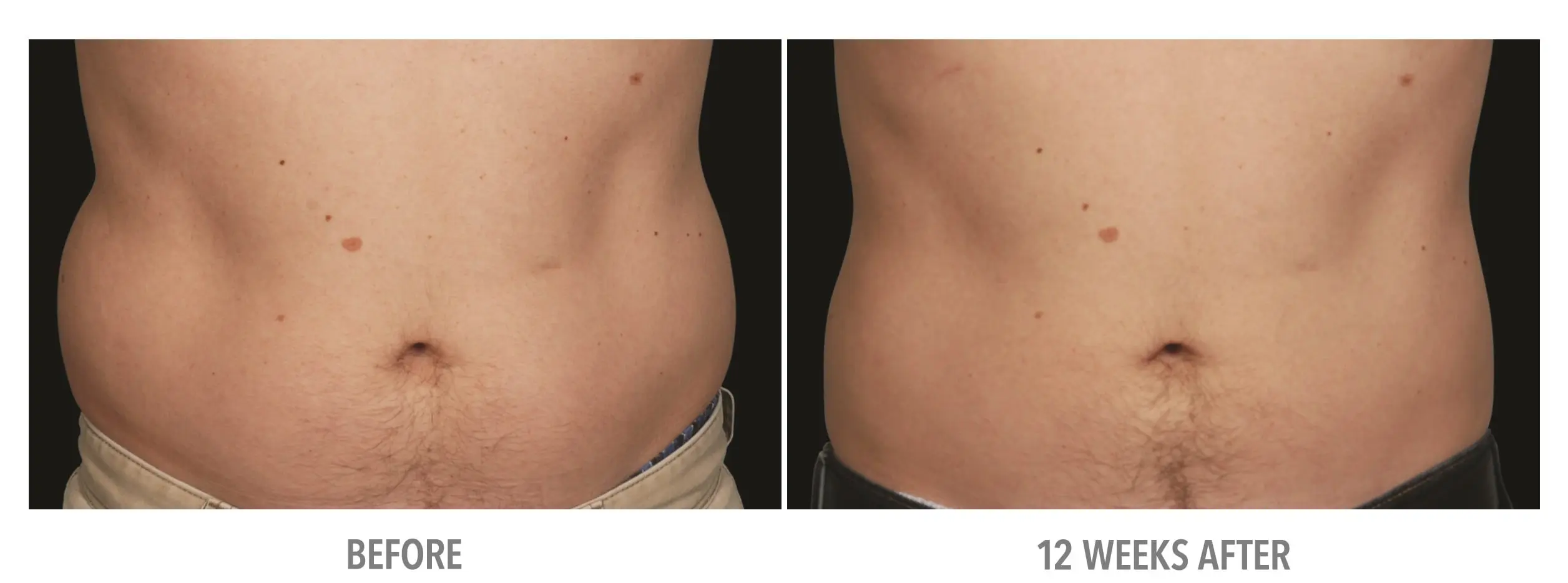 Abdomen