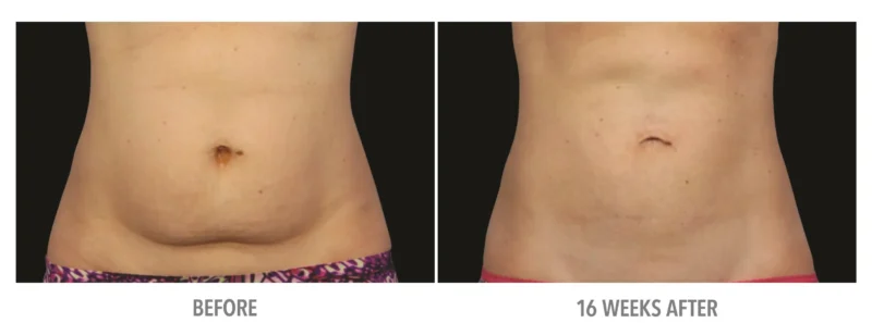 Abdomen