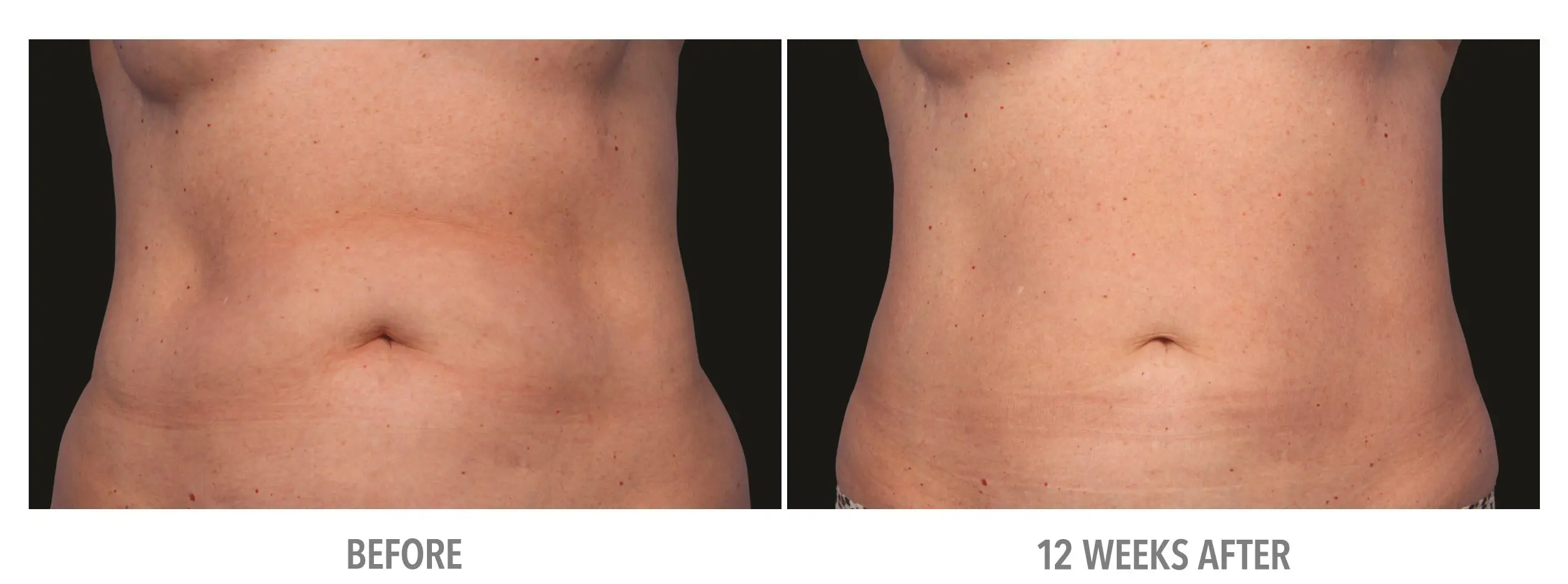 Abdomen