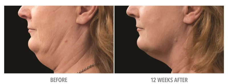 Neck